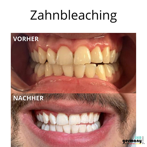 Zahnbleaching Behandlung