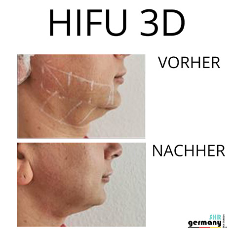 Hifu 3D Behandlung