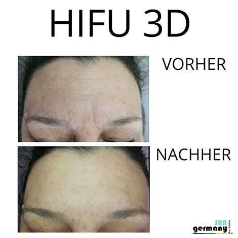 Hifu3D Behandlung